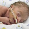 Sindrome de dificultad respiratoria neonatal